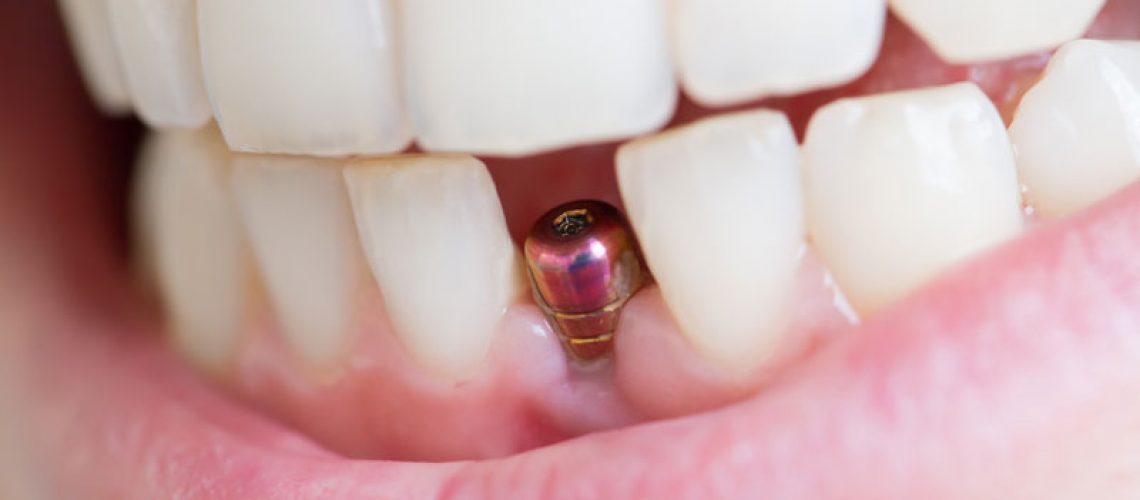 an image of a patients smile that has the top of a dental implant post showing in the missing tooth area in the patients lower arch.