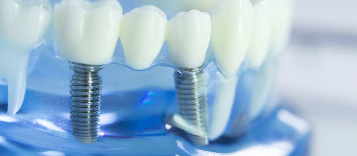 a dental implant model that can be used by an oral surgeon to show people how dental implants can restore their smiles.