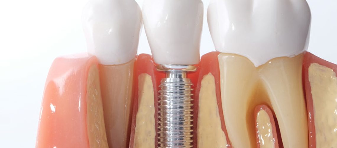 dental-implant-model-bone-cutaway-1-x