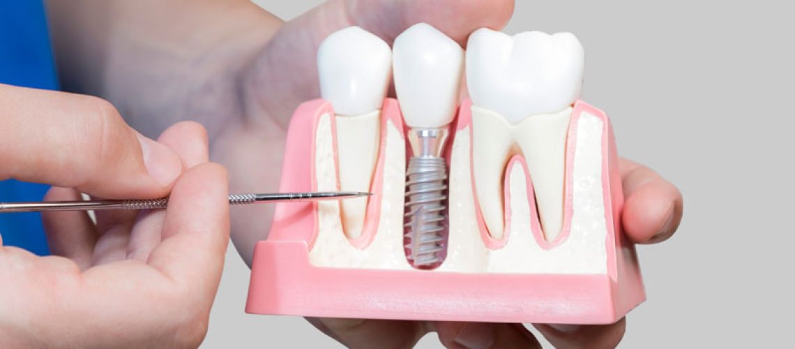 Dental Assistant Showing Off A Dental Implant In A Jawbone Cutaway Model in Denton, TX