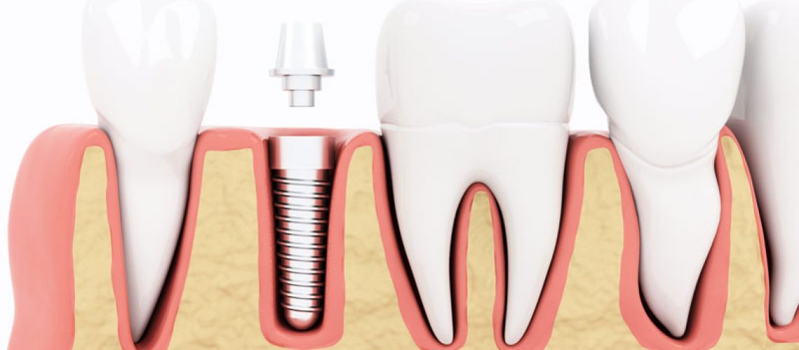 Cross-sectional 3D illustration of dental implant placed in jaw bone between natural teeth. Implant post embedded in the bone, ready for a dental crown