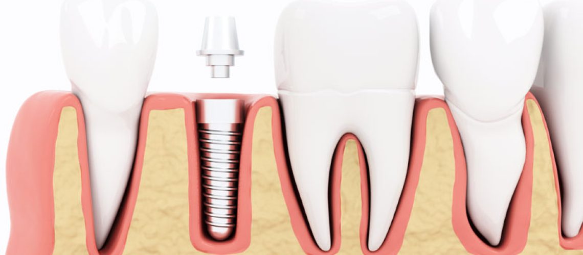 Cross-sectional 3D illustration of dental implant placed in jaw bone between natural teeth. Implant post embedded in the bone, ready for a dental crown