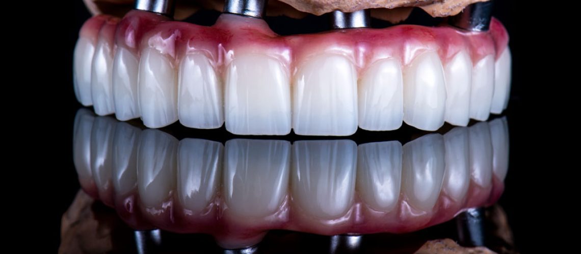 dental-implants-2