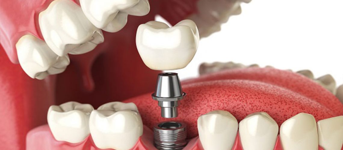 single dental implant model presentation