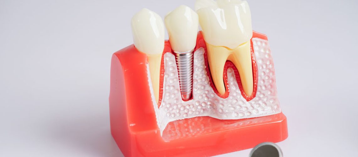 dental-implants-3