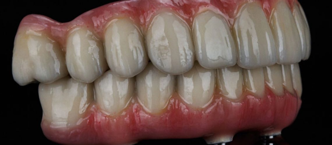 A detailed image of a full-mouth dental implant prosthesis featuring realistic upper and lower arches with lifelike ceramic teeth and pink gum base, shown on a black background. A detailed image of a full-mouth dental implant prosthesis featuring realistic upper and lower arches with lifelike ceramic teeth and pink gum base, shown on a black background.
