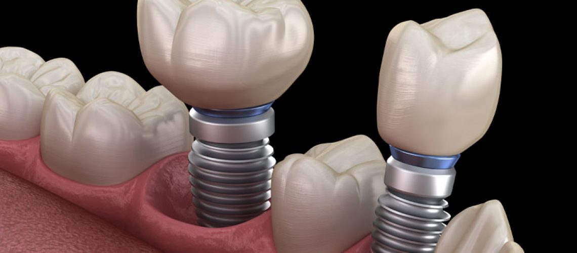 Two Single Dental Implants In A Gumline