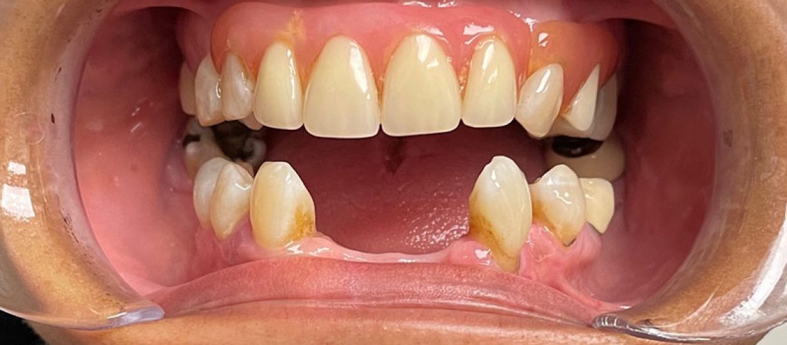 denture