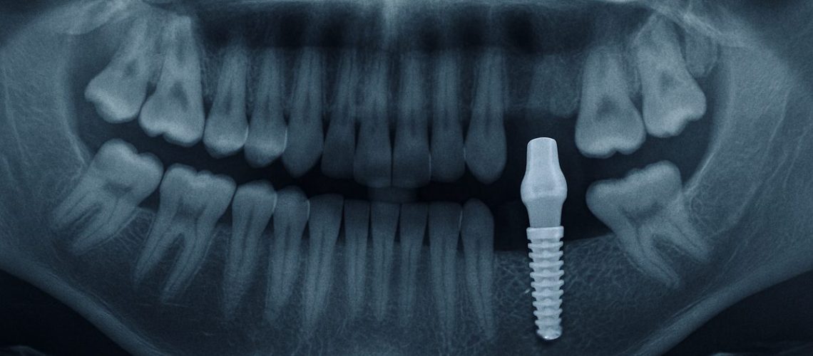 Image of a mouth x-ray showing a dental implant in the lower jaw, with an emphasis on the implant integrating with the jaw bone. No text on the image.