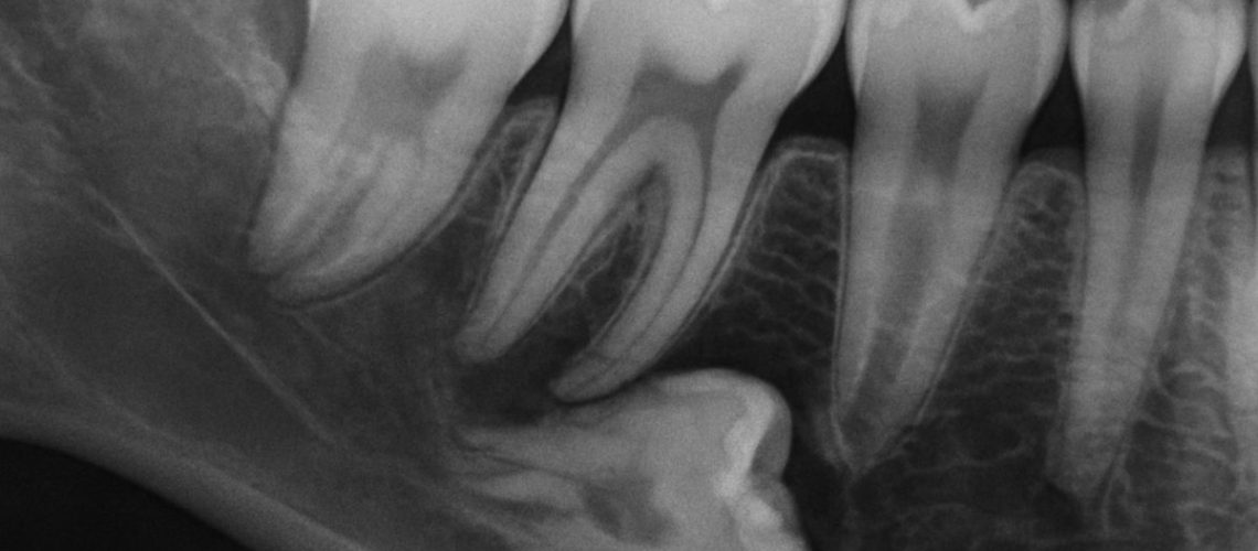 A close-up x-ray of bottom wisdom teeth impacted in the jaw, with one tooth pressing against the adjacent molar, causing potential damage. No text on image.
