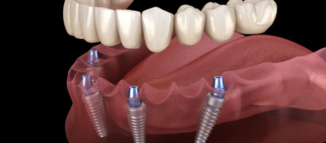 a full arch dental implant model that shows how the dental implant posts, abutments, and prosthesis can be accurately placed with InstaRisa's 3.0 3D facial scanner.