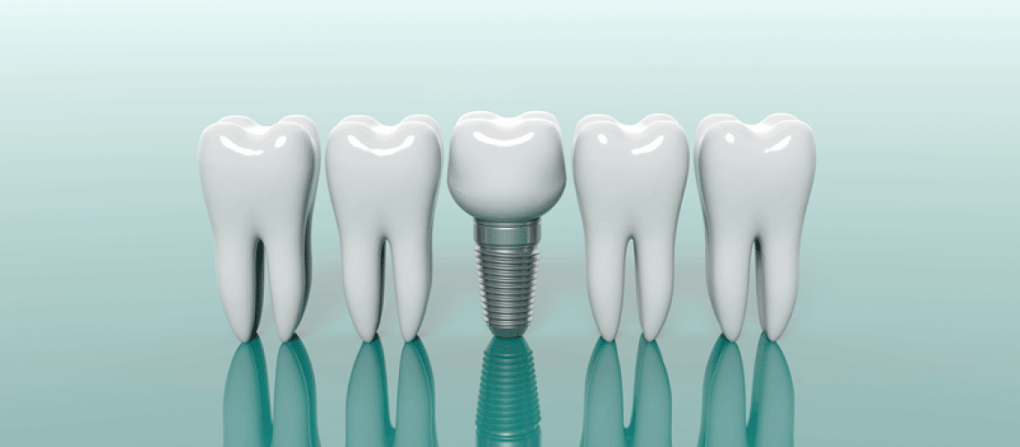 3d model of 4 teeth with a dental implant in the middle of them