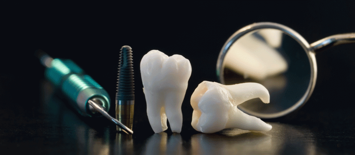 models of dental tools and implants and crowns on a reflective table