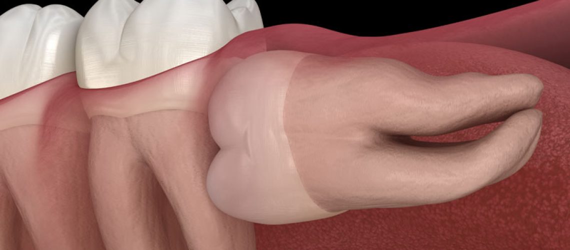 An image of an impacted wisdom tooth.