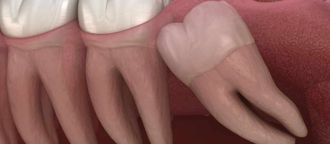 a model of what typical impacted wisdom teeth look like below the gum line.