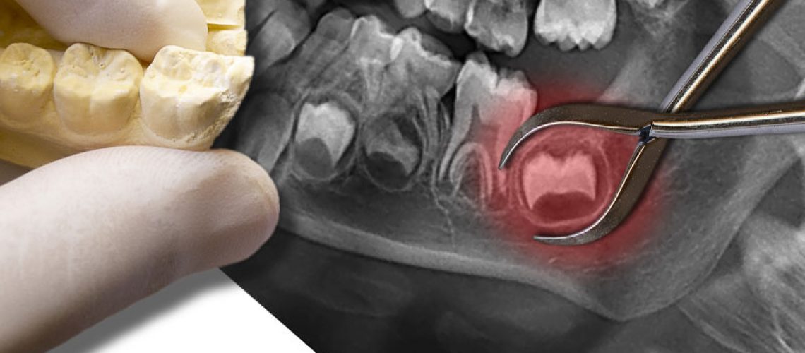 an image of an impacted wisdom tooth.