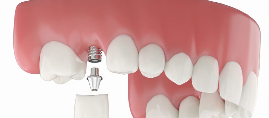 3D Illustration of Dental implant model replacement in the upper jaw. a metal implant post embedded in the jaw, all set against a white background.