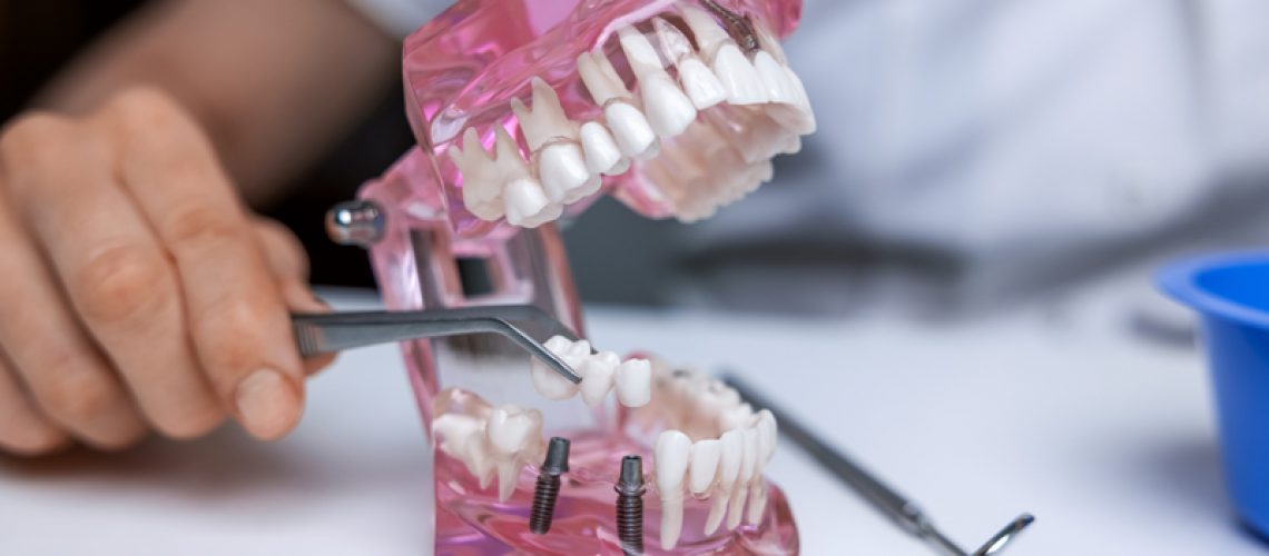 dentist implantologist showing dental bridge implant technology on human tooth jaw model.