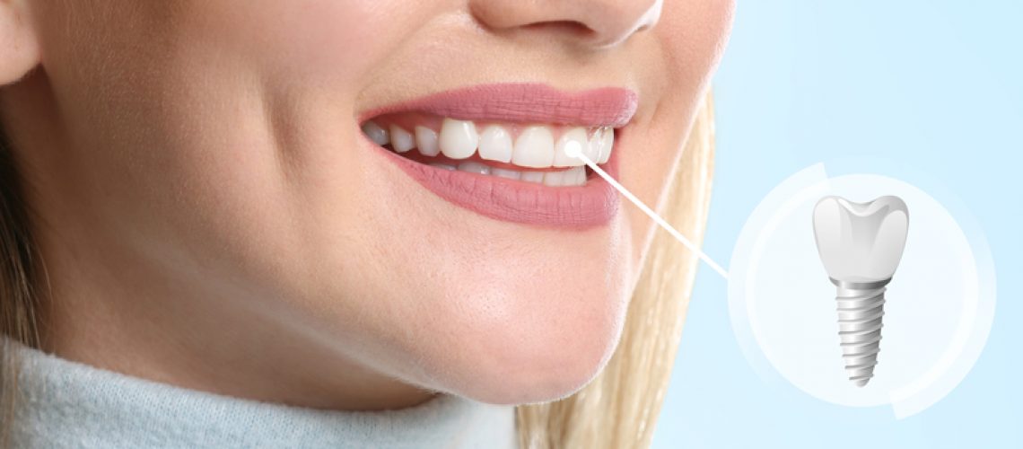 Young woman with implanted teeth on color background, closeup.