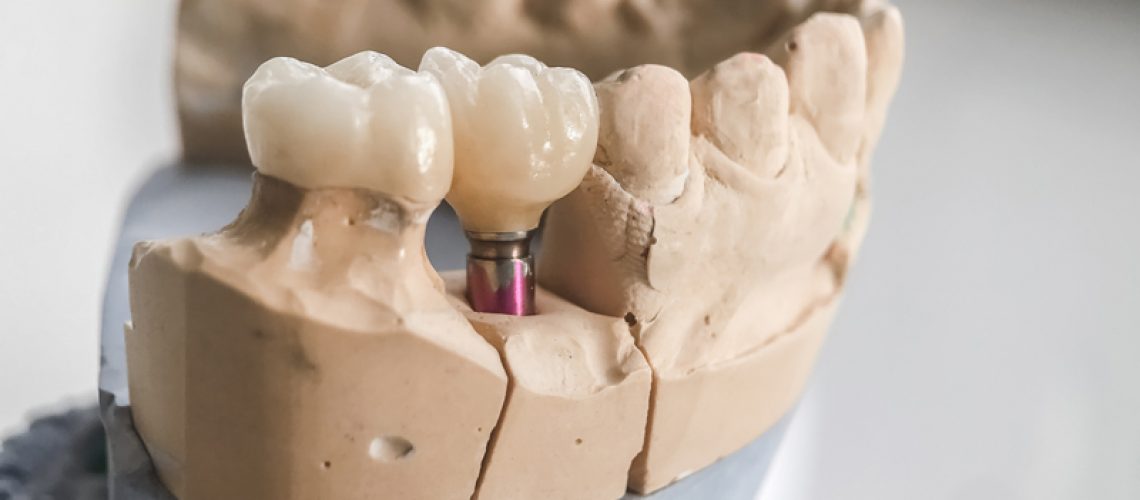Image of a prosthesis jaw with a implant.