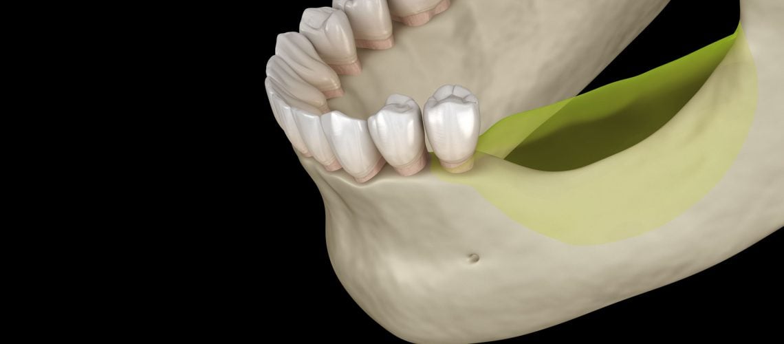 jaw bone loss