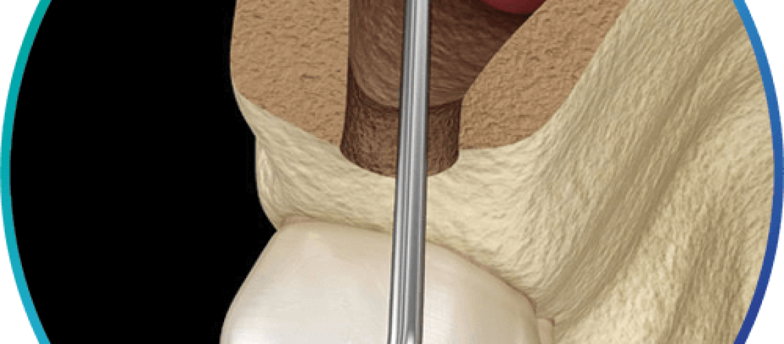 sinus lift graphic