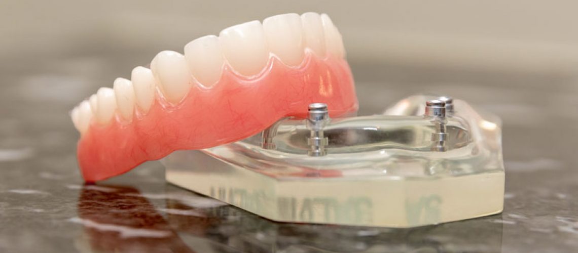Showcasing a top view of an All-on-4 dental implant model, demonstrating how four titanium posts are precisely implanted into the jawbone to support a full arch of prosthetic teeth, highlighting the innovative solution for full mouth rehabilitation.