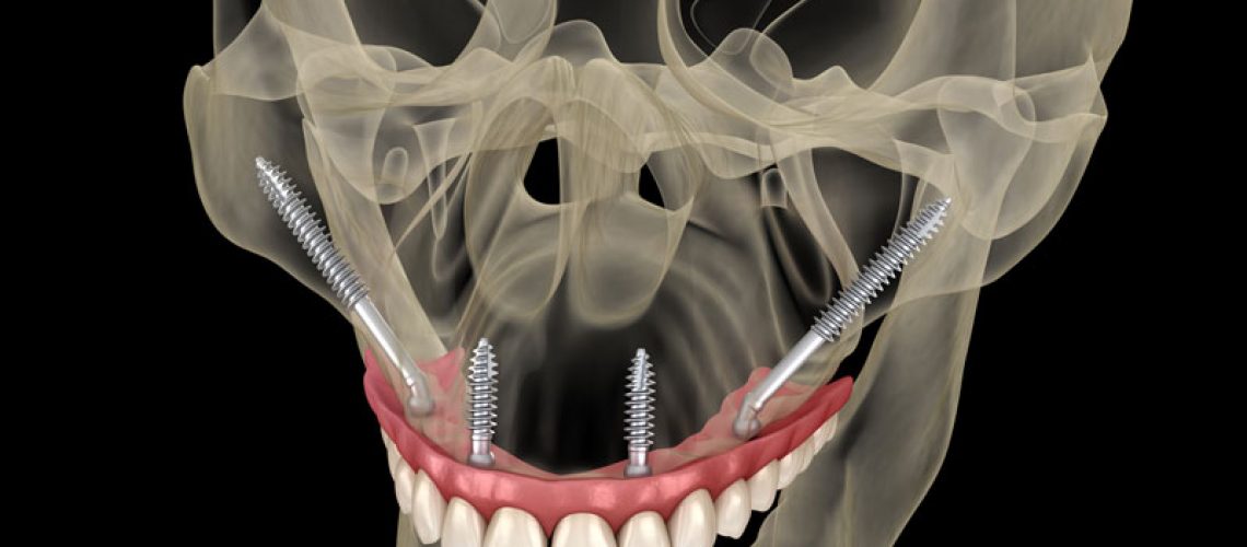 image of zygomatic dental implants model.
